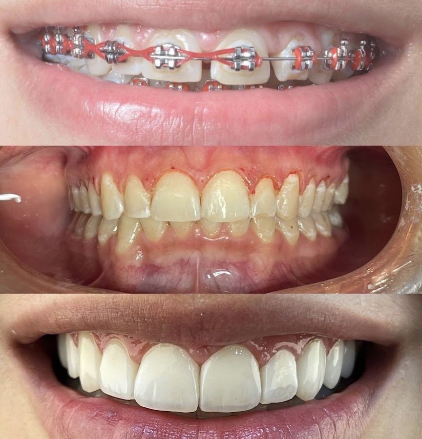 Facetas em resina — resultado realista